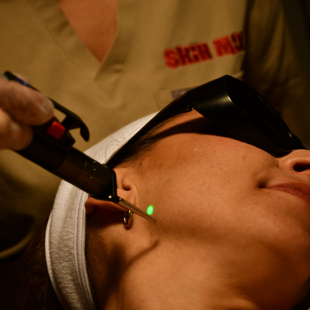 How Laser Facials Help My Skin